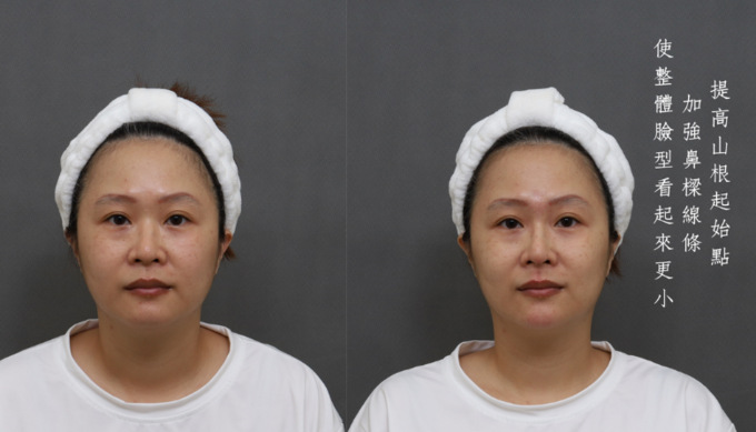 玻尿酸,玻尿酸隆鼻,下巴填充,微整形,永蘊聯合診所,喬雅登玻尿酸