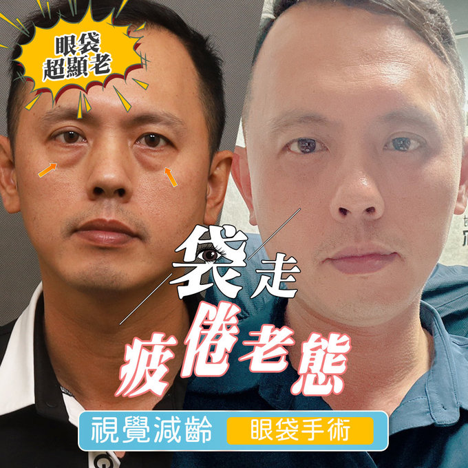 眼袋，眼袋手術，台中眼袋手術推薦，大里眼袋手術，眼袋內開，淚溝，黑眼圈，改善黑眼圈