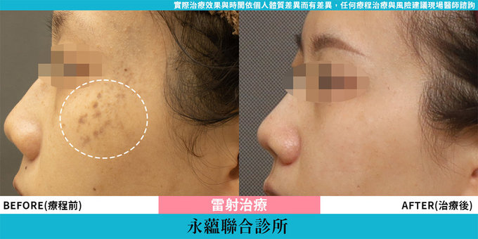 皮秒雷射,台中皮秒雷射,大里皮秒雷射,皮秒雷射大里推薦,台中皮秒雷射診所