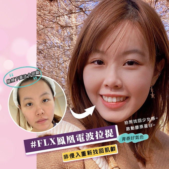 電波拉提，台中電波拉提，鳳凰電波，大里電波拉提推薦，鳳凰電波林心如，童顏針，舒顏萃，台中打電波