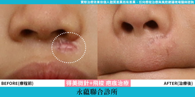 疤痕治療，得美微針疤痕治療，飛梭雷射疤痕治療